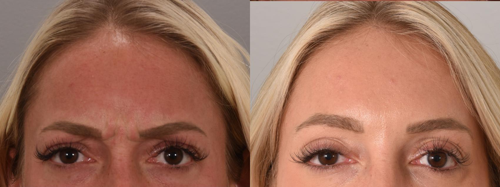 Forehead Case 158 Before & After Glabellar | Rochester, NY | Q the Medical Spa