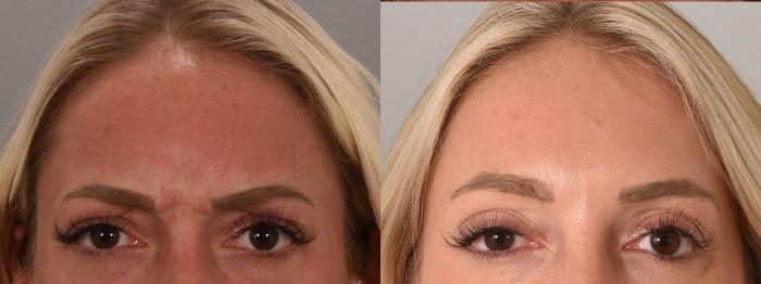 Forehead Case 158 Before & After Glabellar | Rochester, NY | Q the Medical Spa
