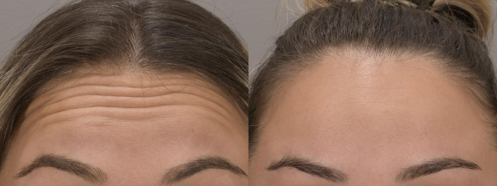 Forehead Case 159 Before & After Front | Rochester, NY | Q the Medical Spa