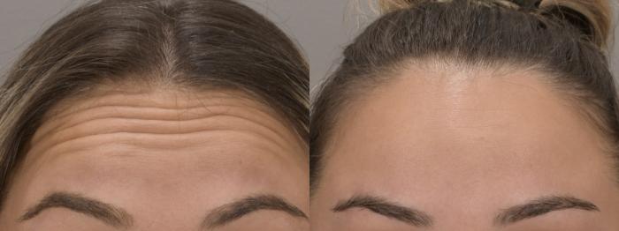 Forehead Case 159 Before & After Front | Rochester, NY | Q the Medical Spa