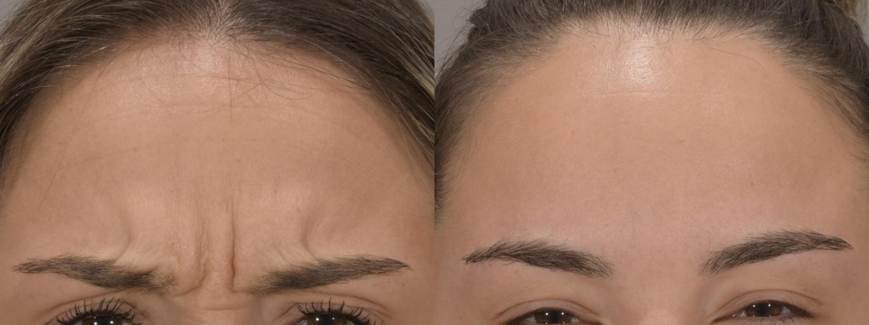 Forehead Case 159 Before & After Glabellar | Rochester, NY | Q the Medical Spa