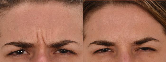 Forehead Case 160 Before & After Glabellar | Rochester, NY | Q the Medical Spa