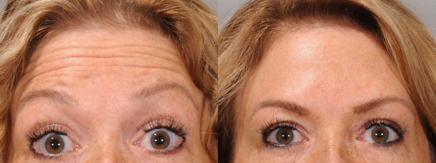 Glabella Case 168 Before & After Front | Rochester, NY | Q the Medical Spa