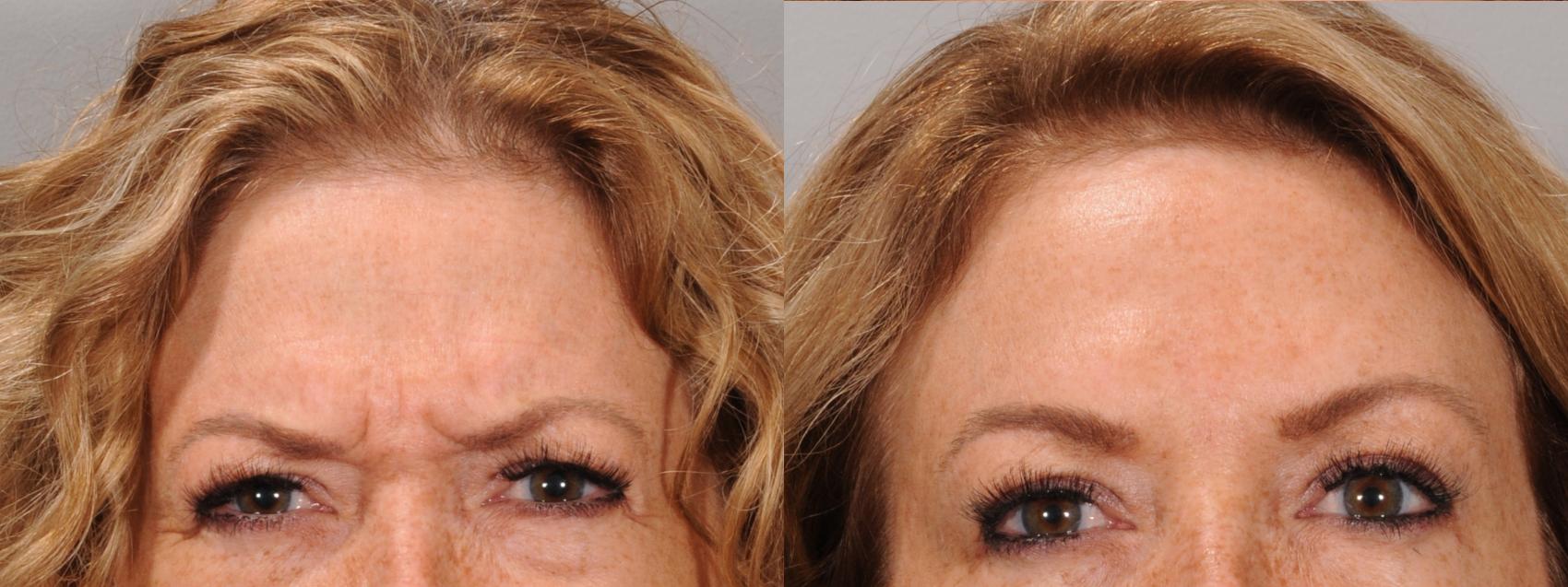 Glabella Case 168 Before & After Glabellar | Rochester, NY | Q the Medical Spa