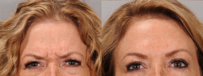 Glabella Case 168 Before & After Glabellar | Rochester, NY | Q the Medical Spa