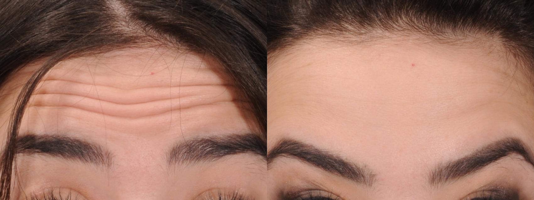 Glabella Case 169 Before & After Front | Rochester, NY | Q the Medical Spa