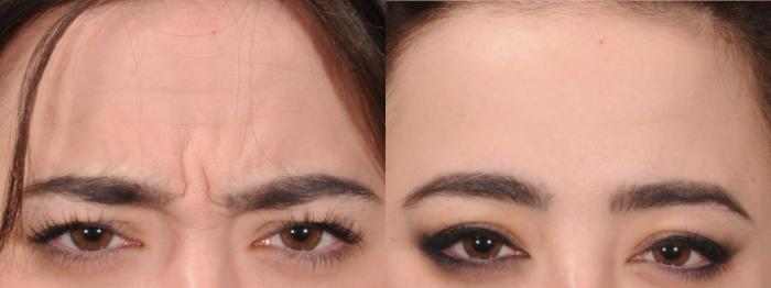 Glabella Case 169 Before & After Glabellar | Rochester, NY | Q the Medical Spa