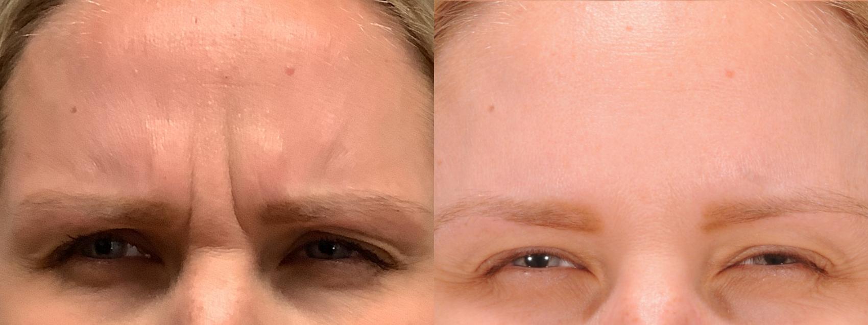 Forehead Case 171 Before & After Glabellar | Rochester, NY | Q the Medical Spa