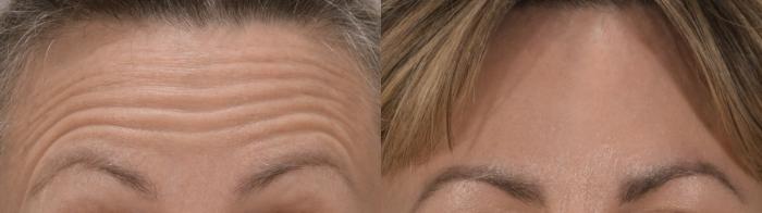 Forehead Case 216 Before & After Front | Rochester, NY | Q the Medical Spa