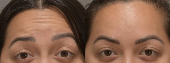 Forehead Case 232 Before & After Front | Rochester, NY | Q the Medical Spa