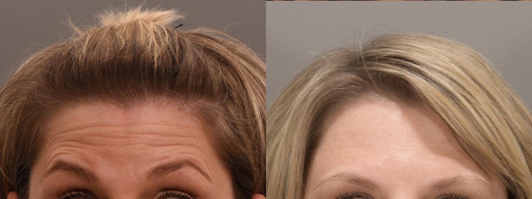 Forehead Case 234 Before & After Front | Rochester, NY | Q the Medical Spa