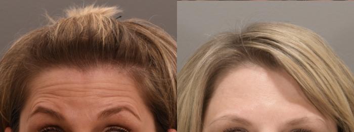 Forehead Case 234 Before & After Front | Rochester, NY | Q the Medical Spa