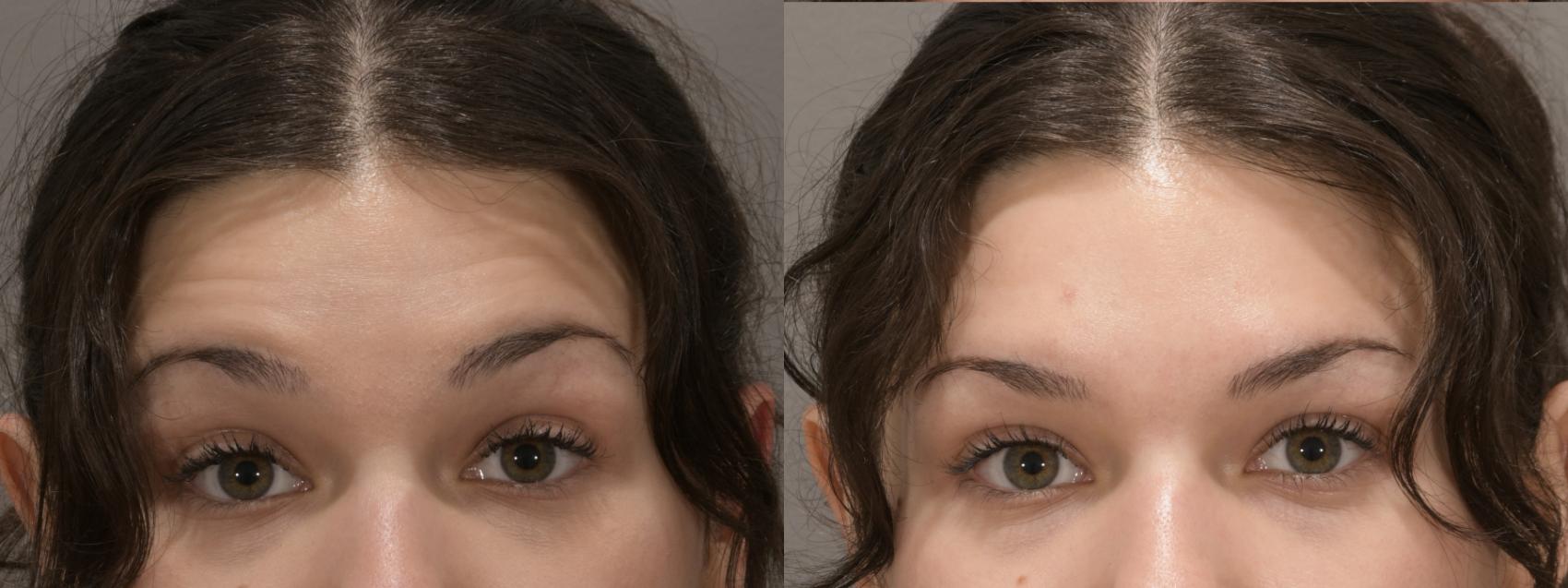 Forehead Case 235 Before & After Front | Rochester, NY | Q the Medical Spa