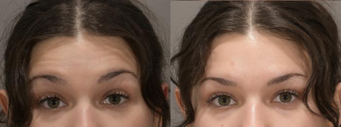 Forehead Case 235 Before & After Front | Rochester, NY | Q the Medical Spa