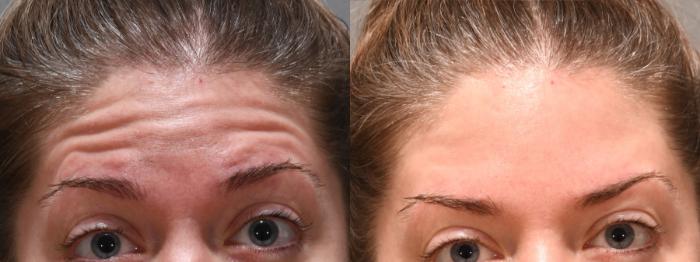 Forehead Case 242 Before & After Front | Rochester, NY | Q the Medical Spa