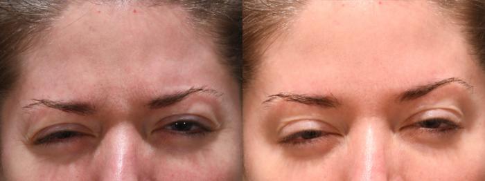 Forehead Case 242 Before & After Glabella | Rochester, NY | Q the Medical Spa