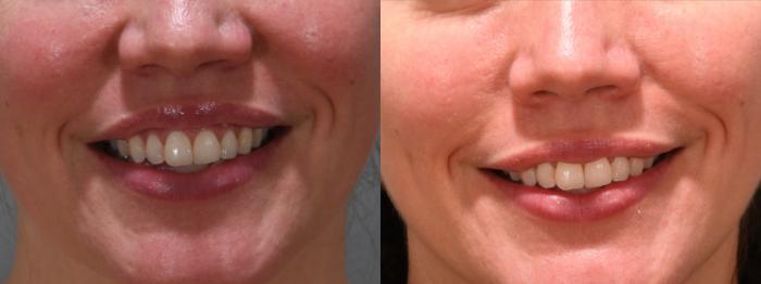 Forehead Case 242 Before & After Gummy Smile | Rochester, NY | Q the Medical Spa