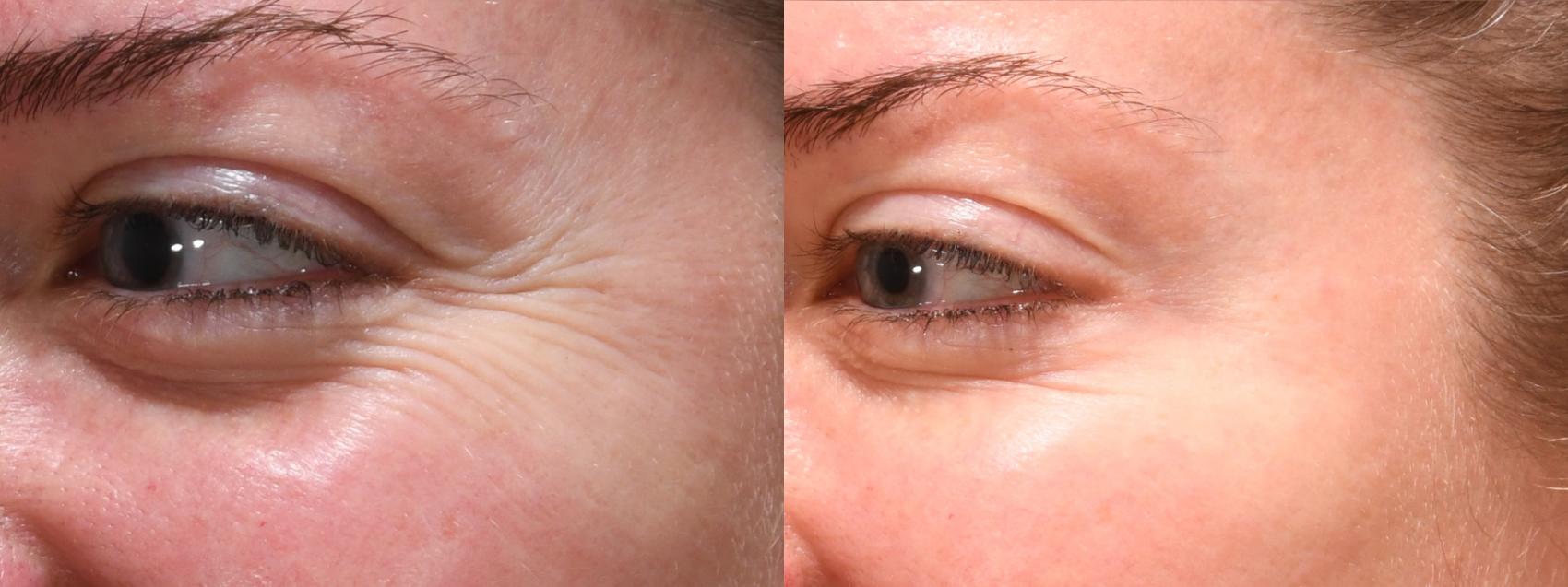 Forehead Case 242 Before & After Left Oblique | Rochester, NY | Q the Medical Spa