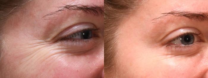 Forehead Case 242 Before & After Right Oblique | Rochester, NY | Q the Medical Spa