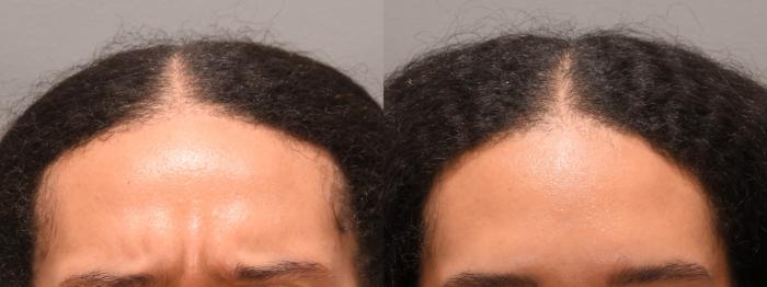 Forehead Case 243 Before & After Glabella | Rochester, NY | Q the Medical Spa