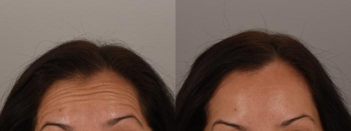 Forehead Case 244 Before & After Front | Rochester, NY | Q the Medical Spa