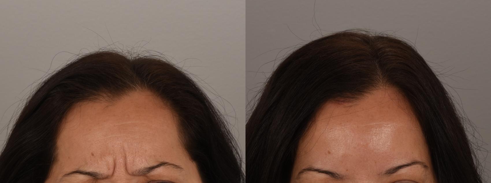 Forehead Case 244 Before & After Glabella | Rochester, NY | Q the Medical Spa