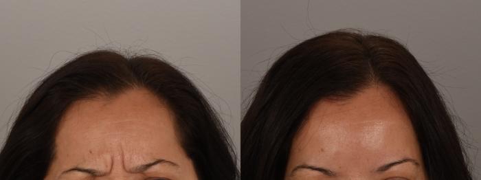 Forehead Case 244 Before & After Glabella | Rochester, NY | Q the Medical Spa