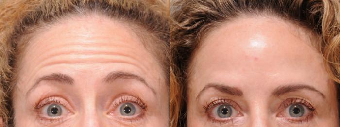 Forehead Botox Case 139 Before & After Front | Rochester, NY | Q the Medical Spa