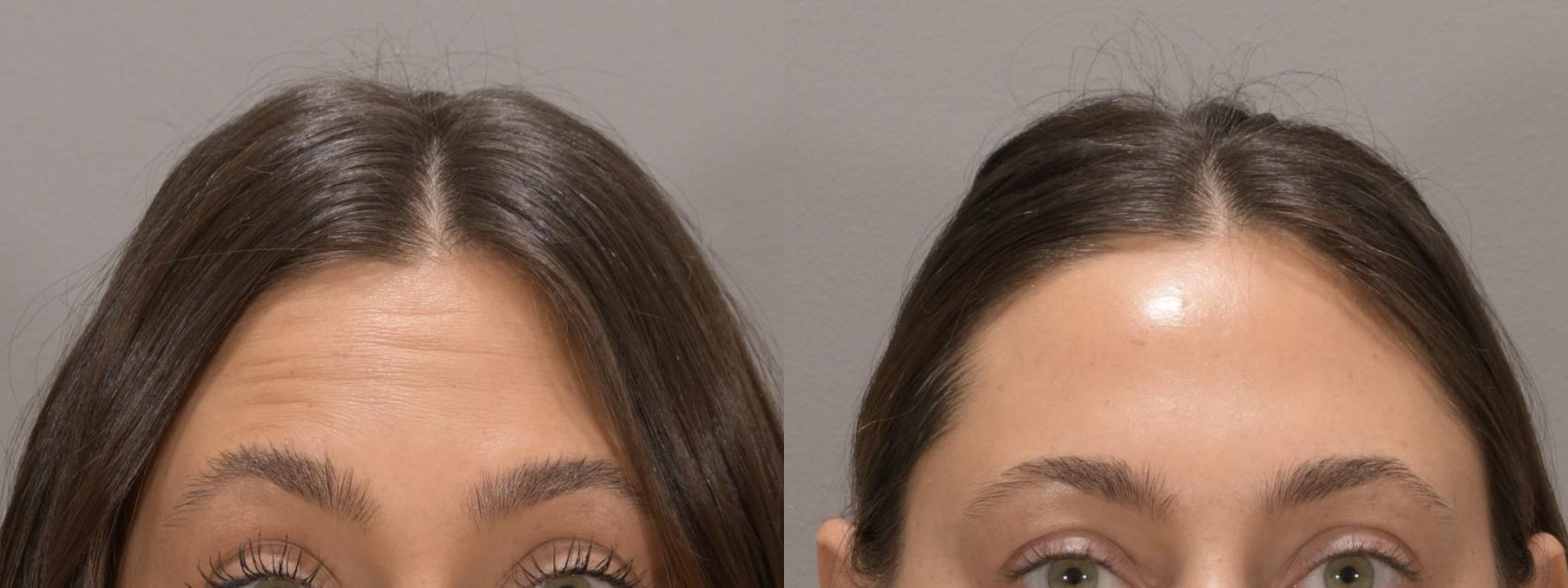 Forehead Botox Case 161 Before & After Front | Rochester, NY | Q the Medical Spa