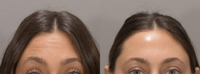 Forehead Botox Case 161 Before & After Front | Rochester, NY | Q the Medical Spa