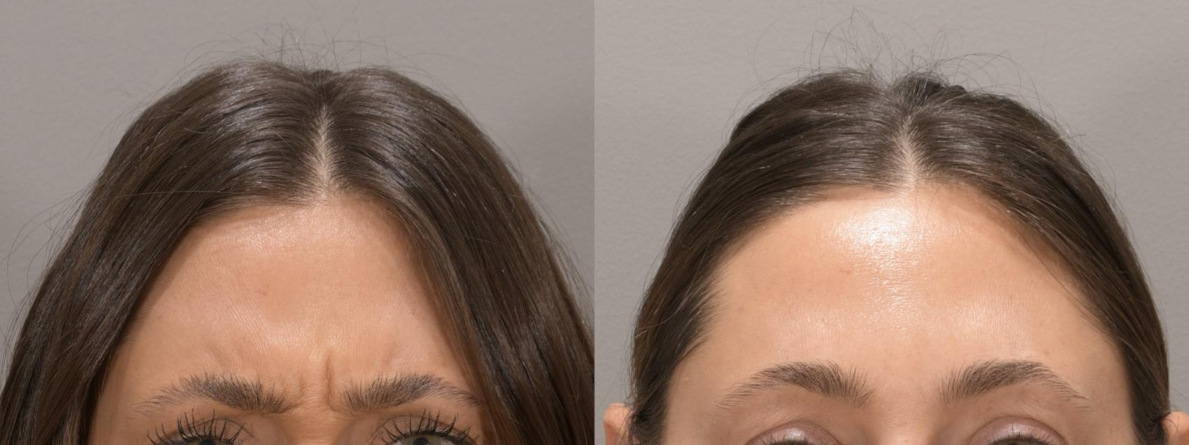 Forehead Botox Case 161 Before & After Glabellar | Rochester, NY | Q the Medical Spa