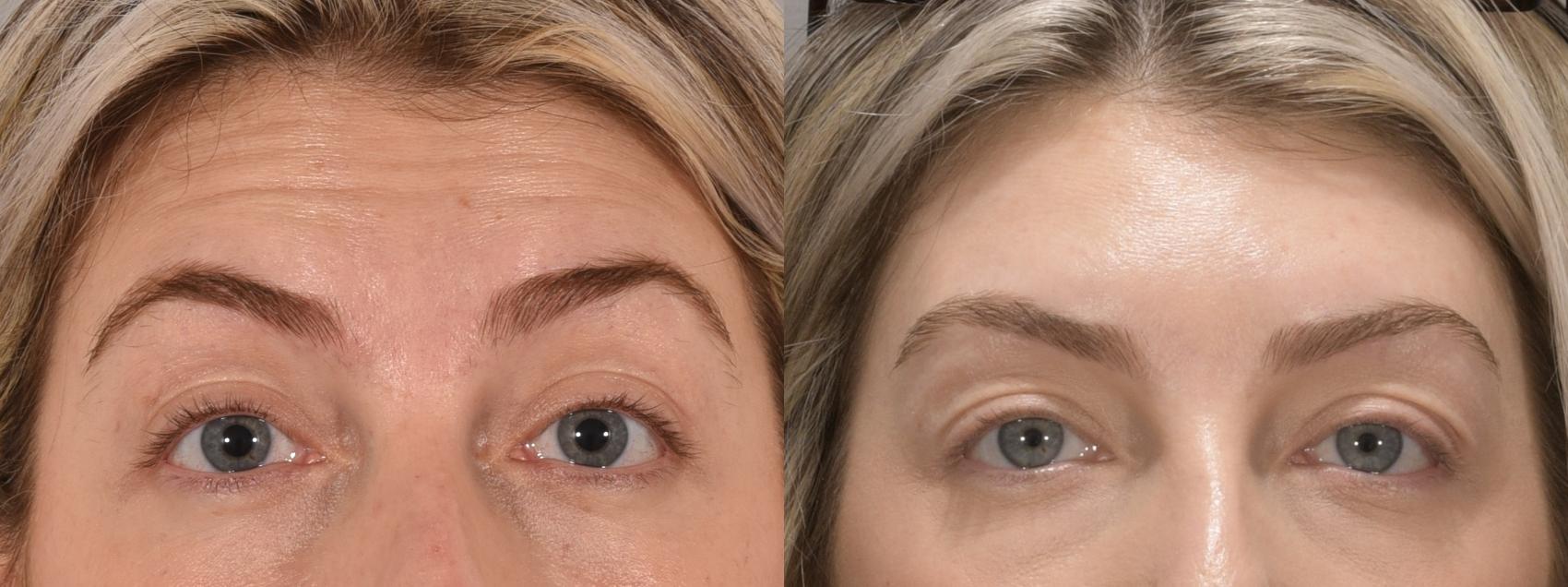 Forehead Botox Case 162 Before & After Front | Rochester, NY | Q the Medical Spa