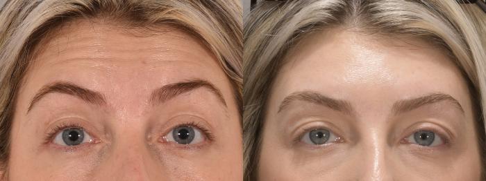 Forehead Botox Case 162 Before & After Front | Rochester, NY | Q the Medical Spa