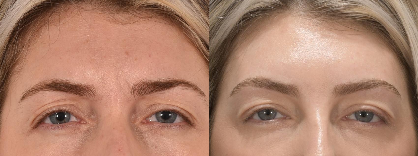 Forehead Botox Case 162 Before & After Glabellar | Rochester, NY | Q the Medical Spa