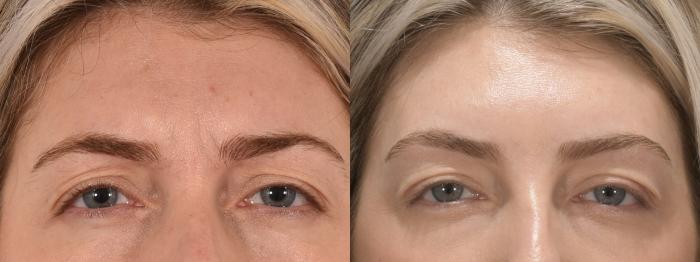 Forehead Botox Case 162 Before & After Glabellar | Rochester, NY | Q the Medical Spa