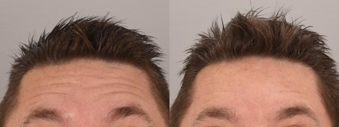 Forehead Botox Case 163 Before & After Front | Rochester, NY | Q the Medical Spa