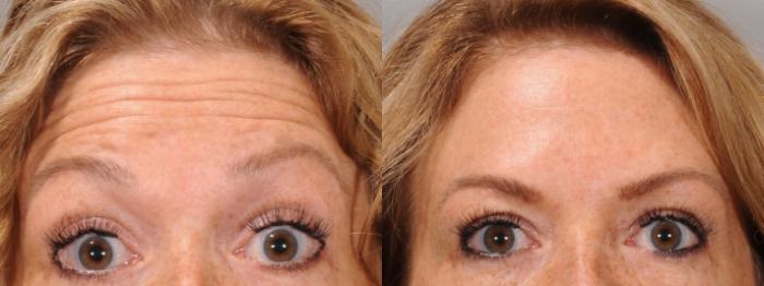 Forehead Botox Case 168 Before & After Front | Rochester, NY | Q the Medical Spa