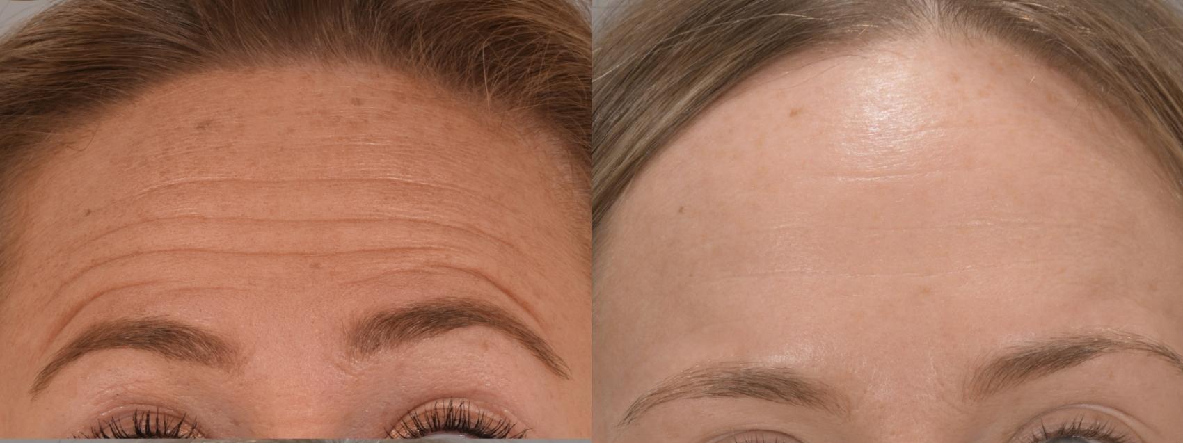 Forehead Botox Case 173 Before & After Front | Rochester, NY | Q the Medical Spa