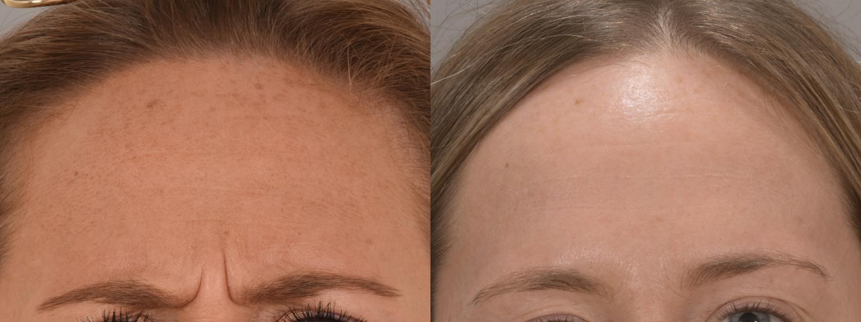 Forehead Botox Case 173 Before & After Glabellar | Rochester, NY | Q the Medical Spa