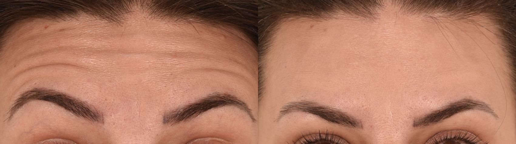 Forehead Botox Case 214 Before & After Front | Rochester, NY | Q the Medical Spa