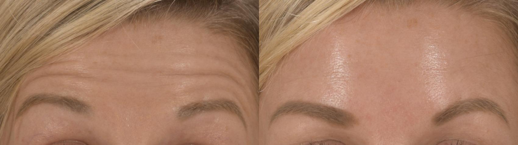 Forehead Botox Case 215 Before & After Front | Rochester, NY | Q the Medical Spa