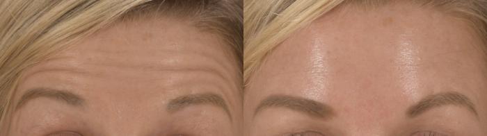Forehead Botox Case 215 Before & After Front | Rochester, NY | Q the Medical Spa
