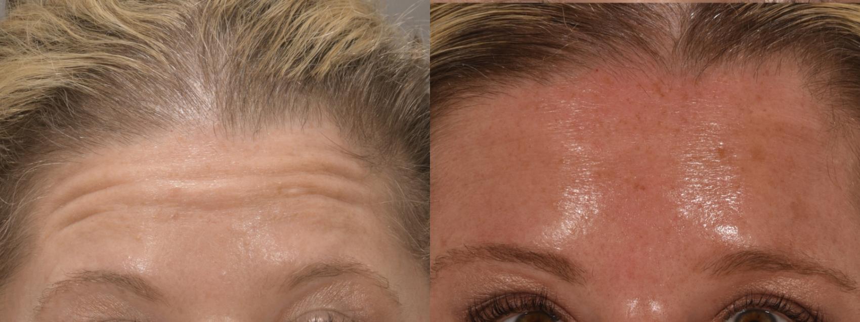 Forehead Botox Case 220 Before & After Front | Rochester, NY | Q the Medical Spa