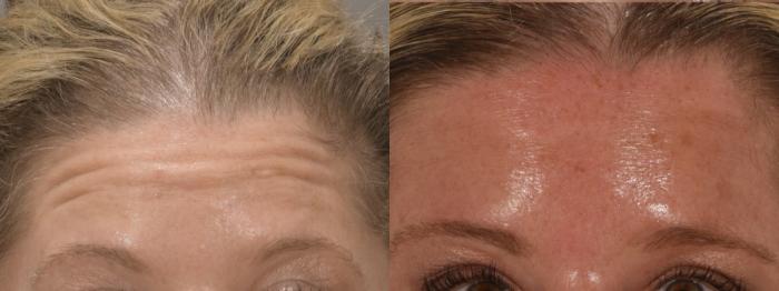 Forehead Botox Case 220 Before & After Front | Rochester, NY | Q the Medical Spa