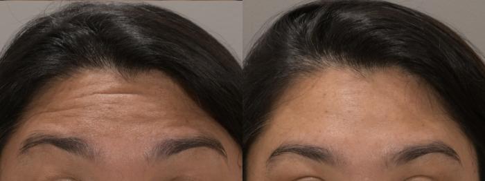 Forehead Botox Case 228 Before & After Front | Rochester, NY | Q the Medical Spa