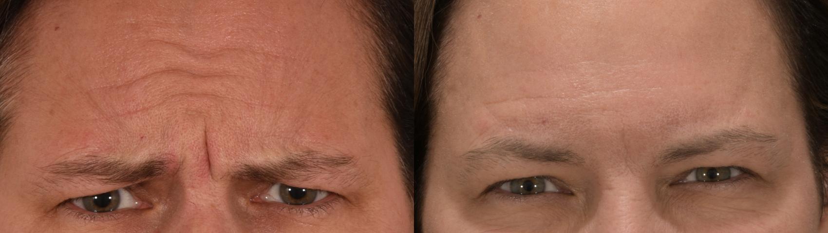 Glabella Case 229 Before & After Front | Rochester, NY | Q the Medical Spa
