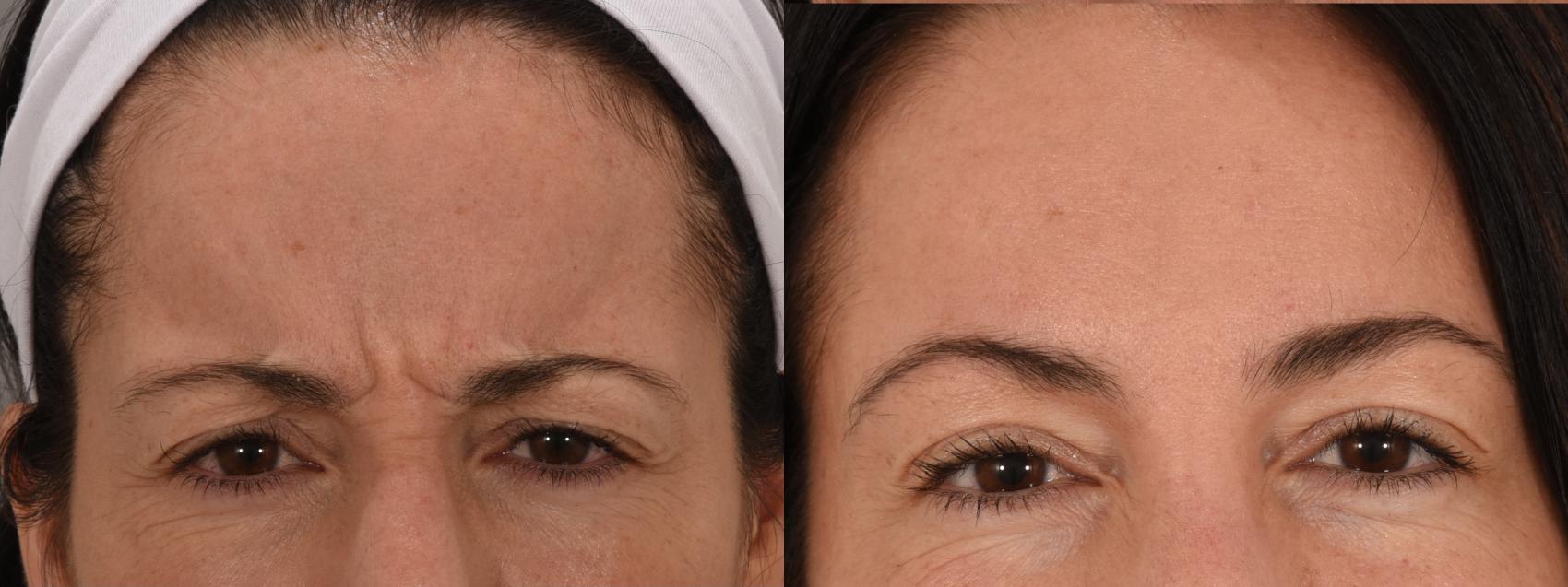 Glabella Case 237 Before & After Front | Rochester, NY | Q the Medical Spa