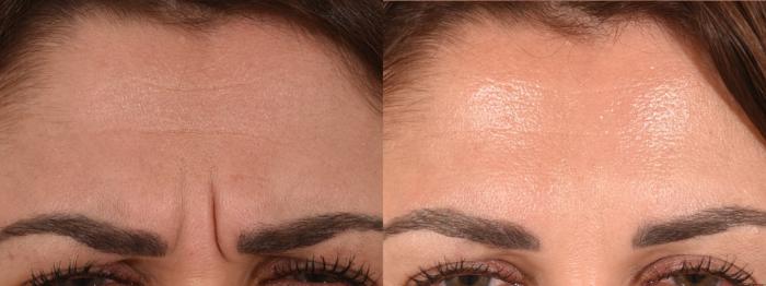 Glabella Botox Case 174 Before & After Front | Rochester, NY | Q the Medical Spa