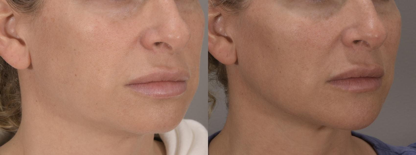 Jawline Case 197 Before & After Right Oblique | Rochester, NY | Q the Medical Spa
