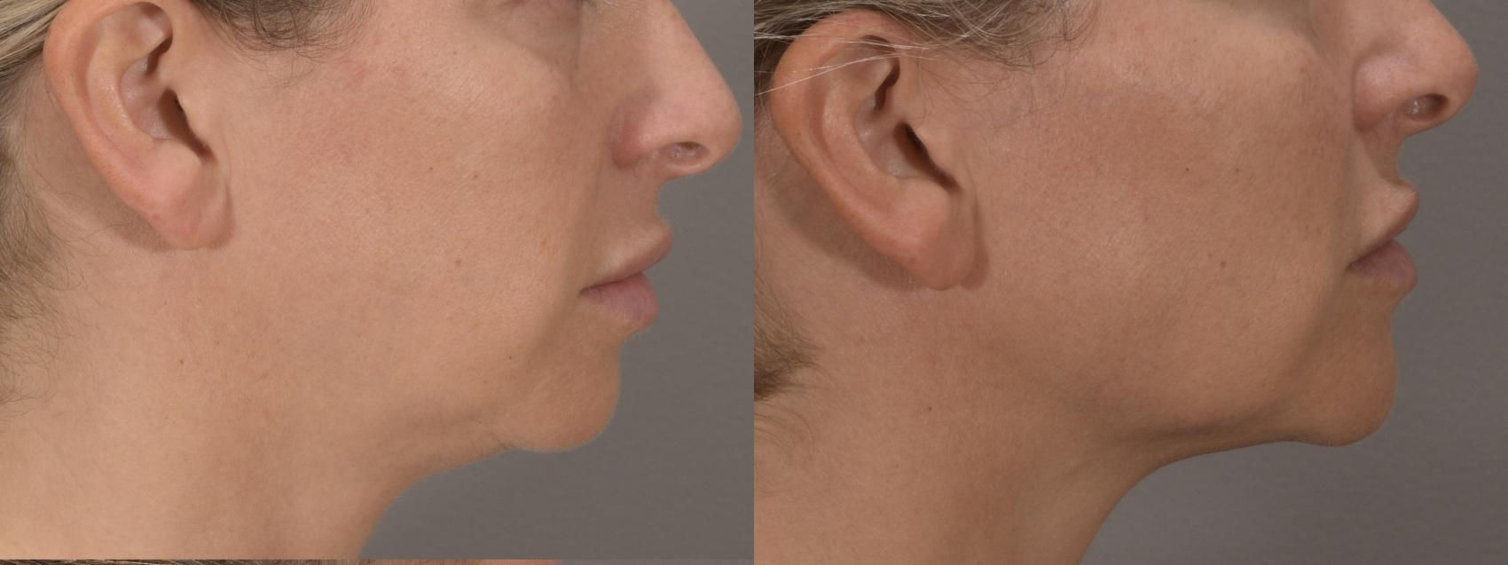Jawline Case 197 Before & After Right Side | Rochester, NY | Q the Medical Spa